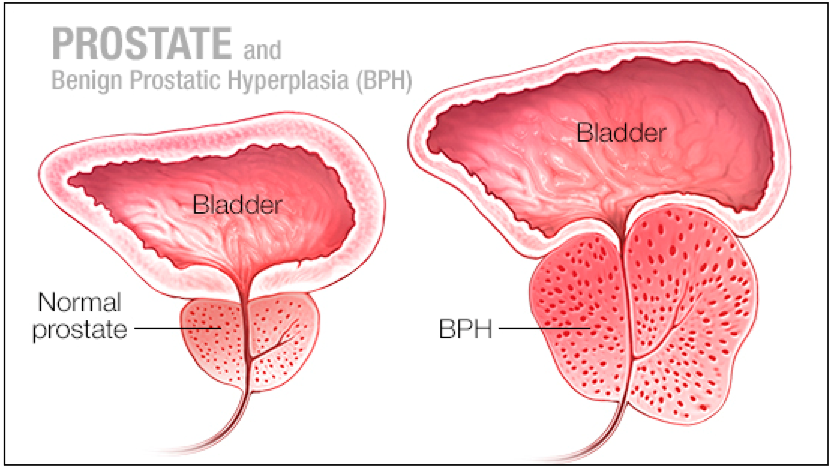 erekcijos metu prostata padidėja kaip varfarinas veikia erekciją