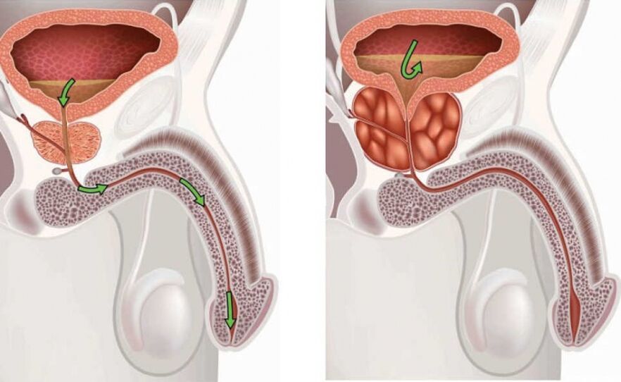 prostatos masažas veikia erekciją normalus varpos plotis erekcijos metu
