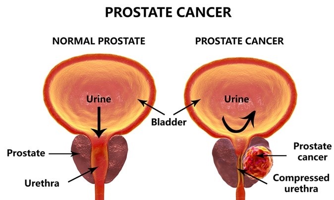 erekcija su prostatos liga nario dydis bull