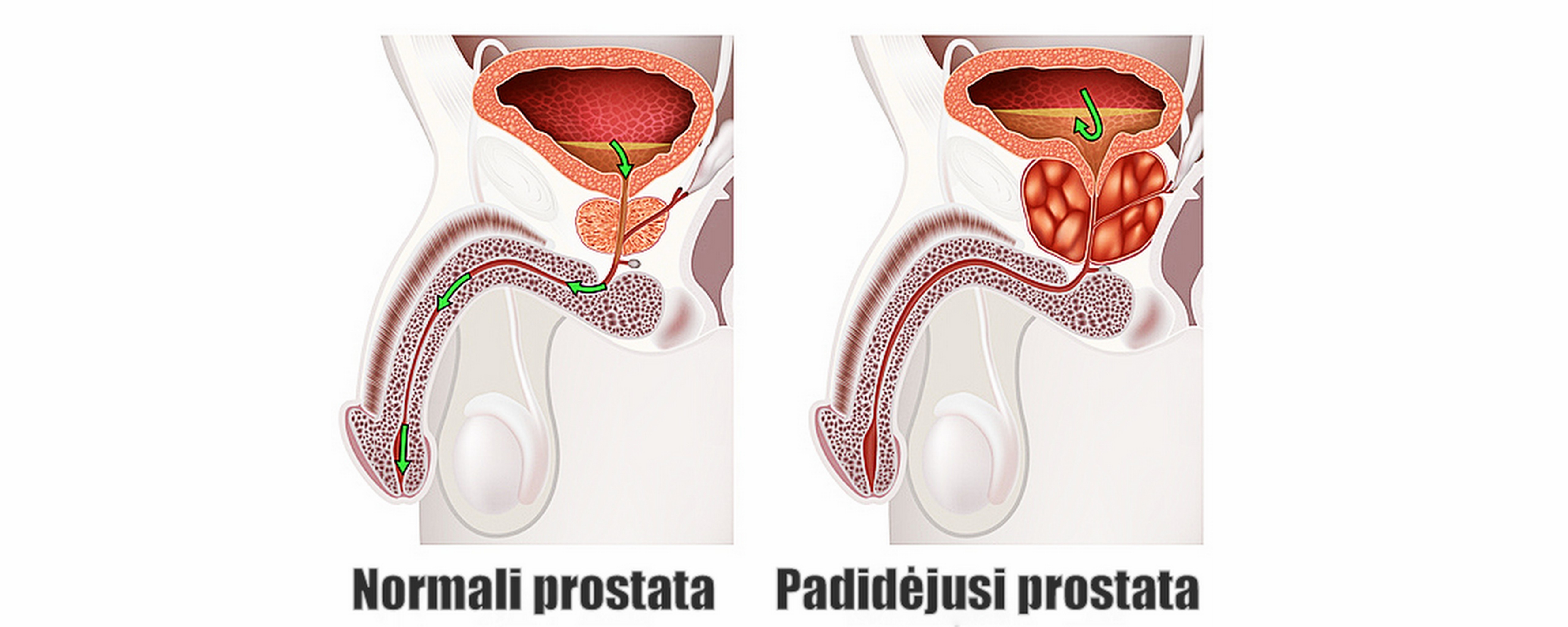 prostatos masažas veikia erekciją puikus storis ir nario ilgis
